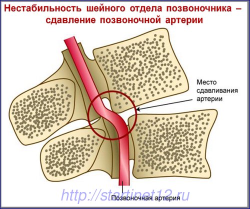Мошенники пугают сдавливанием позвоночной артерии